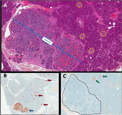 Case report: Insulinomatosis: description of four sporadic cases and review of the literature